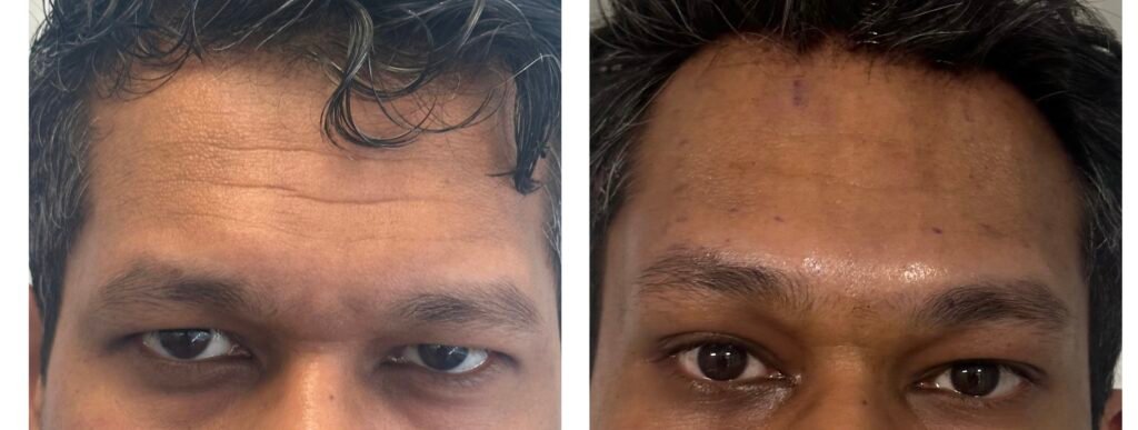 Resultado postoperatorio tras 4 meses de lifting indirecto endoscópico bilateral de cejas