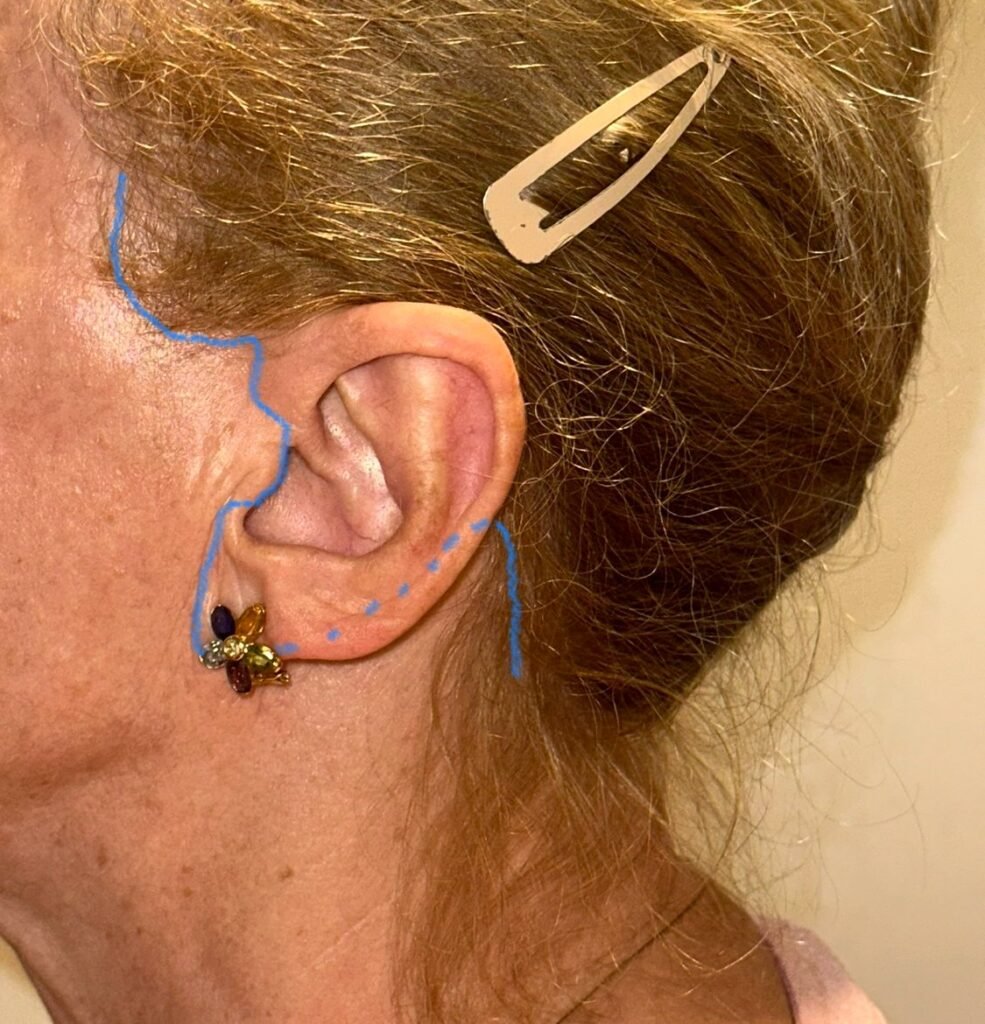 Marcado de incisiones de lifting cervicofacial alrededor de la oreja: trazado temporal, preauricular y retroauricular