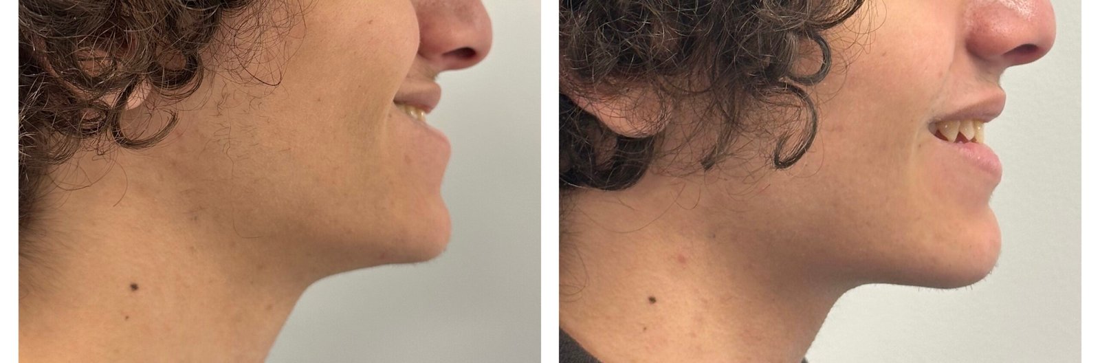 Fotografía de perfil antes y después de cirugía ortognática mandibular - Dr. Gonzalo Botella