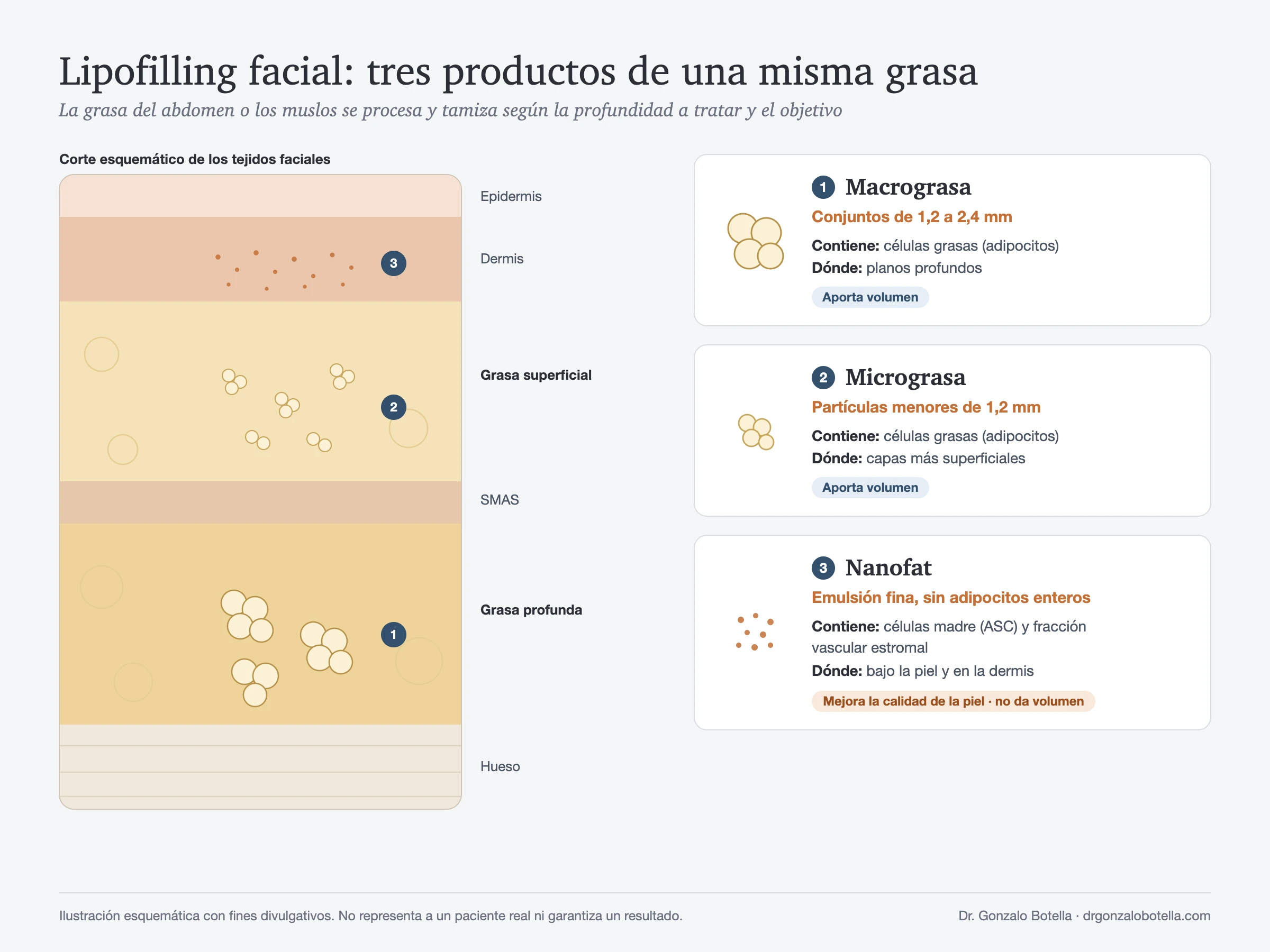 Infografía de lipofilling facial: macrograsa en planos profundos, micrograsa en grasa superficial y nanofat en la dermis