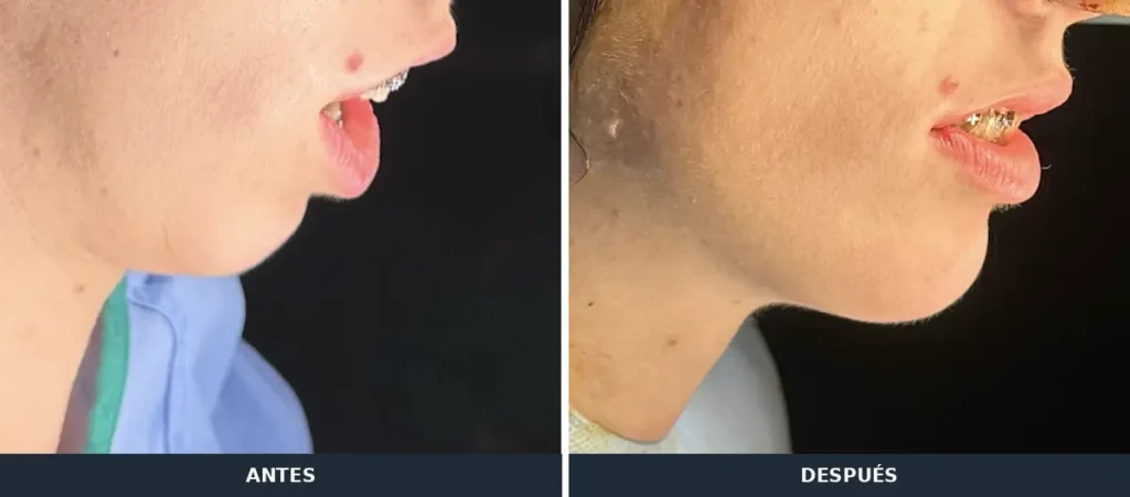 Perfil antes y después de cirugía ortognática en un caso de retrognatia y clase II