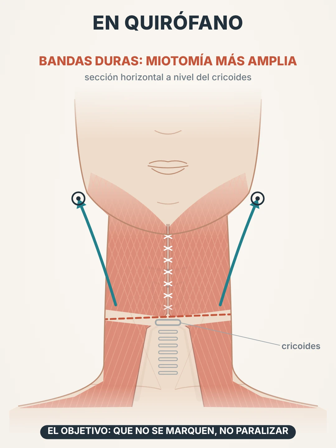 Esquema del tratamiento de las bandas del platisma en el lifting de cuello